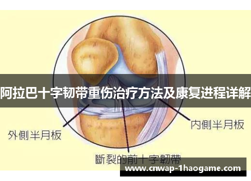 阿拉巴十字韧带重伤治疗方法及康复进程详解